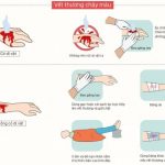 Hướng dẫn xử lý khi bị đứt tay chảy máu